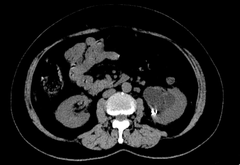 CT2