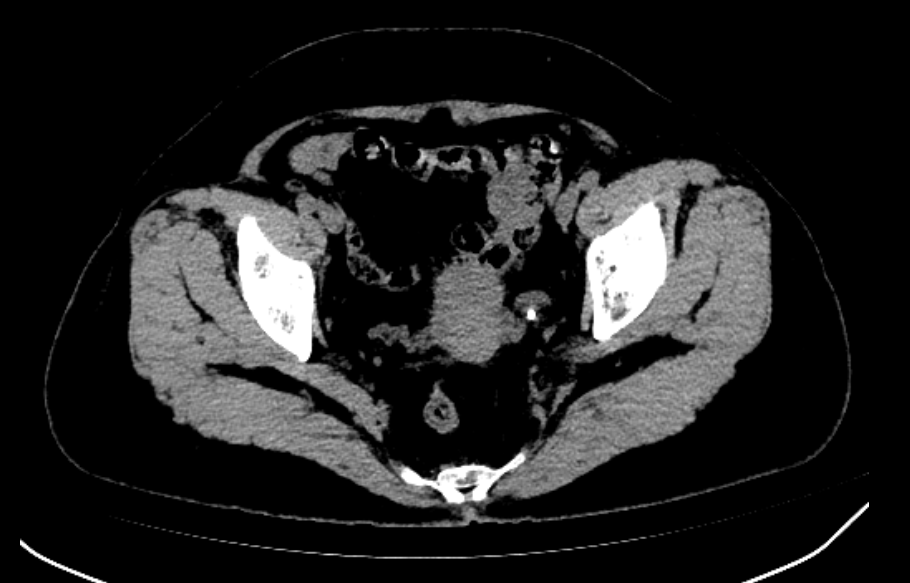 CT4
