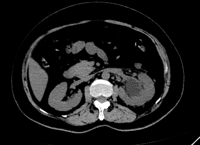 CT1