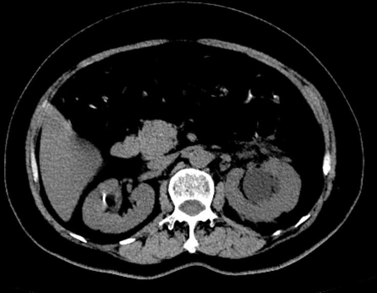 CT3